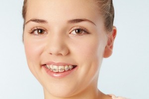 Niềng răng mang lại hàm răng đẹp và nụ cười tự tin