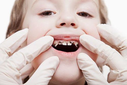 Bệnh sâu răng rất hay gặp ở trẻ nhỏ