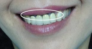 Những nguy cơ từ việc bọc răng sứ kém chất lượng