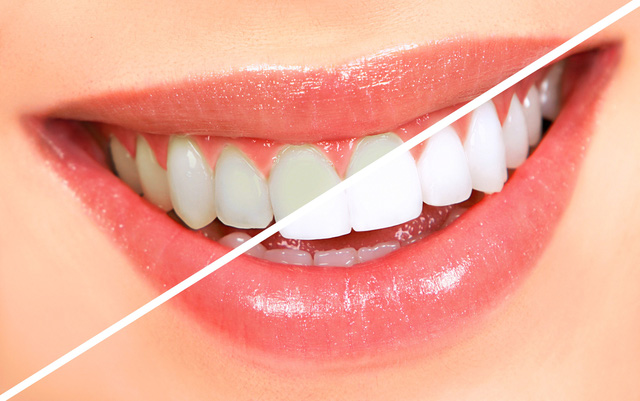 Nguyên nhân gây ê buốt răng sau khi tẩy trắng