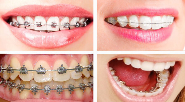 Niềng răng chỉnh nha là phương pháp được nhiều người lựa chọn