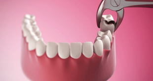 Cần lưu ý điều gì trước và sau khi nhổ răng khôn?