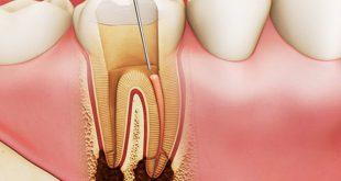 Cùng chuyên gia phục hình răng tìm hiểu quá trình điều trị viêm tủy răng