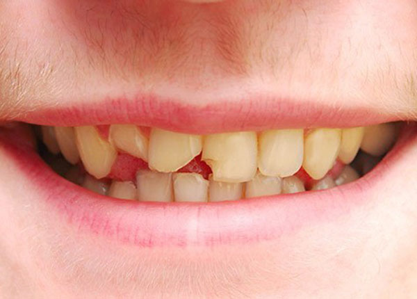 Răng trẻ mọc lệch lạc là do đâu?