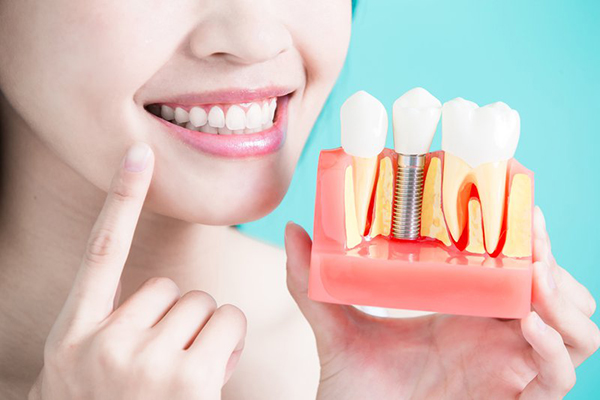 Chăm sóc răng miệng sau khi cấy ghép Implant