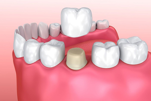 Bọc răng sứ giải pháp phục hồi răng chết tủy