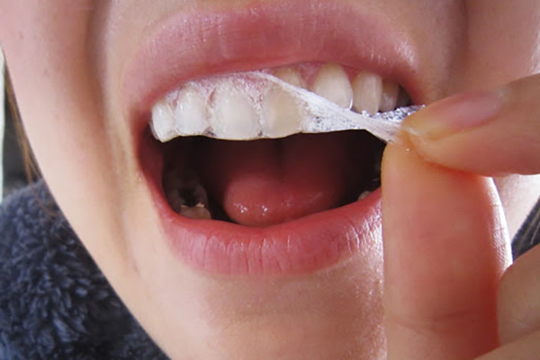 Thận trọng khi sử dụng miếng dán trắng răng