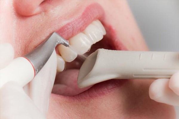 Ảnh hưởng của vôi răng tới sức khỏe răng miệng
