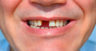 Mất răng ảnh hưởng như thế nào đến sức khỏe?