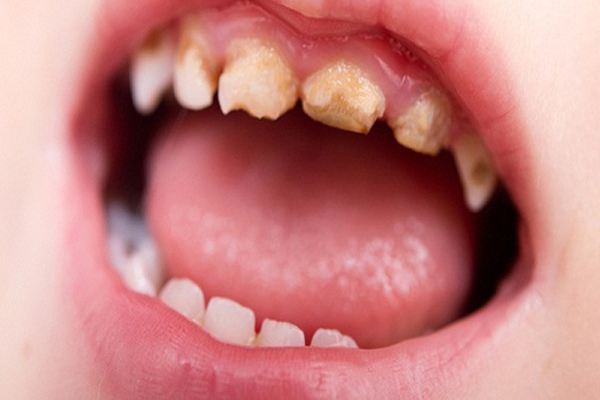 Chăm sóc sức khỏe răng miệng cho trẻ nhỏ