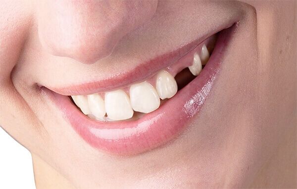 3 bệnh lý răng miệng gây mất răng phổ biến