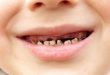 Những trường hợp có nguy cơ cao mắc bệnh sâu răng?