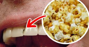 Tổng hợp những loại thực phẩm tác động xấu tới sức khỏe răng miệng