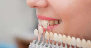 Sự thật về bọc răng sứ thẩm mỹ có thể bạn chưa biết