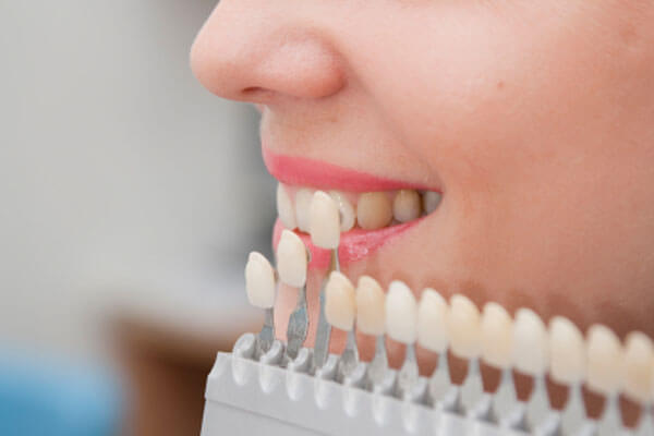 Sự thật về bọc răng sứ thẩm mỹ