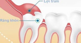 Thông tin và cách xử lý khi răng khôn Lợi Trùm