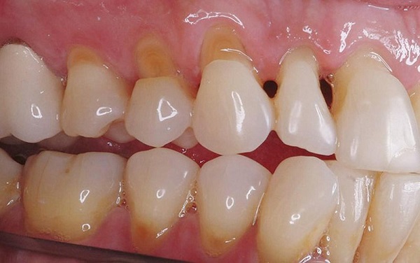 Phòng tránh và điều trị tình trạng khuyết cổ răng
