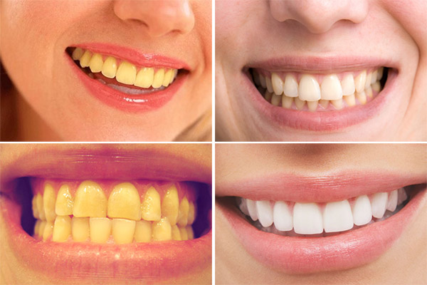 Răng ngả vàng ê buốt là dấu hiệu của mòn men răng