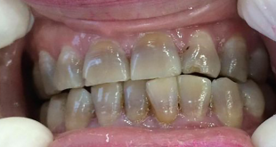 Bắt bệnh răng miệng thông qua màu sắc của răng