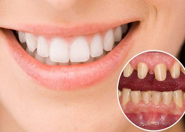 Bọc răng sứ thẩm mỹ áp dụng trong nhiều trường hợp khuyết điểm của răng