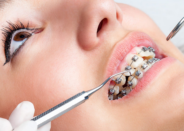 Đánh lún răng là phương pháp làm cho phần xương ở phía trên răng tiêu đi