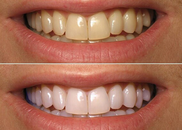 Tẩy trắng răng giúp cải thiện màu sắc răng khi gặp các vấn đề ố vàng