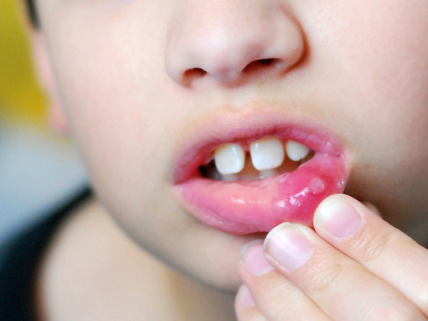 Nở miệng, nhiệt miệng ở trẻ em thì phải làm sao?