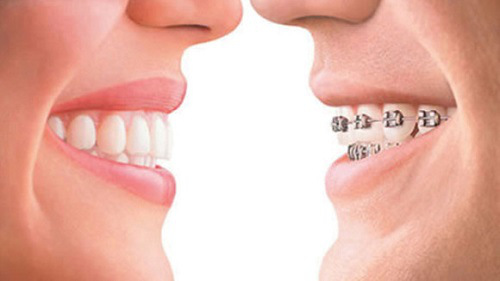 Niềng răng giúp điều chỉnh hàm răng hô, lệch một cách hiệu quả