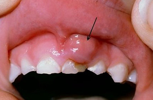 cảnh báo 4 căn bệnh răng lợi thường gặp nhất - 3