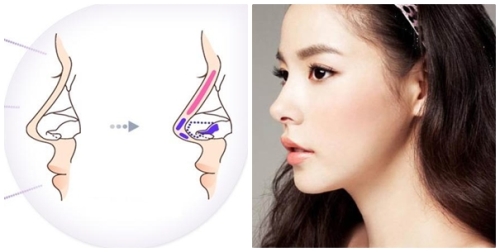 Nâng mũi bằng sụn tự thân hiện nay chiếm khoảng 40% tổng số các ca phẫu thuật nâng mũi