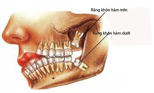 Tại sao gọi là bác sĩ nha khoa gọi là răng khôn?