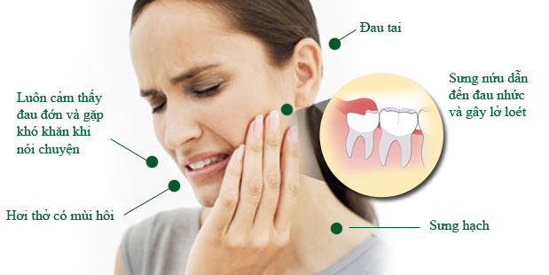 5 thông tin về răng khôn