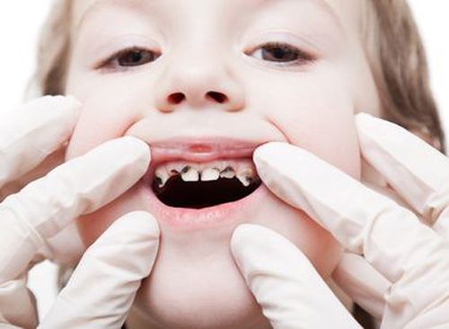 Sâu răng là bệnh răng miệng phổ biến
