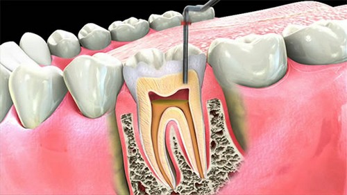 Viêm tủy răng trở nên nguy hiểm khi không phát hiện sớm