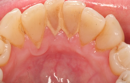 Bệnh răng miệng cao răng