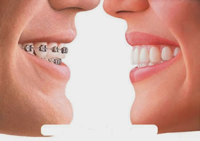 Nên chọn loại răng nào?