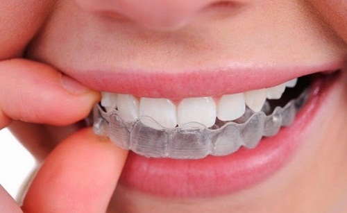 Những lưu ý khi đi phục chỉnh răng