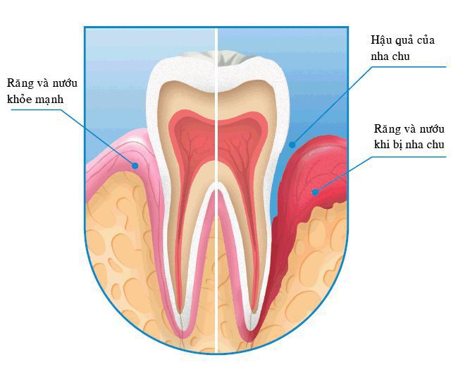 Chẩn đoán bệnh viêm quanh răng bằng hình ảnh Y khoa