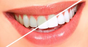 Đi tìm nguyên nhân và cách xử lý khi răng bị ố vàng