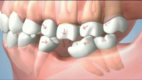 Triệu chứng lâm sàng viêm quanh răng