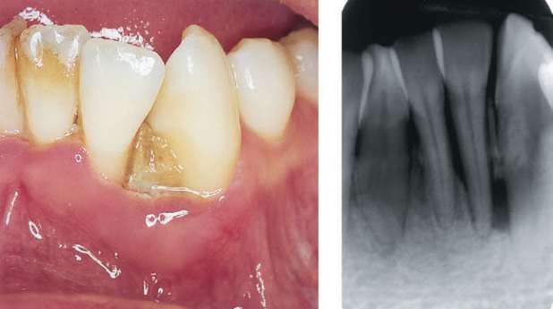 Chẩn đoán bệnh viêm quanh răng
