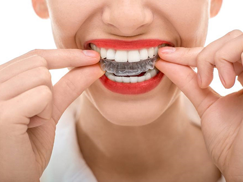 Những biện pháp tẩy trắng răng không phù hợp có thể khiến răng trở nên nhạy cảm