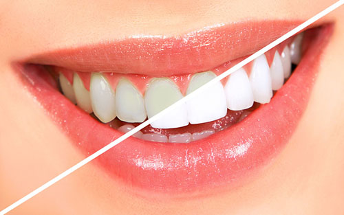 Tẩy trắng răng là phương pháp cải thiện sắc tố răng nhiều người chọn lựa