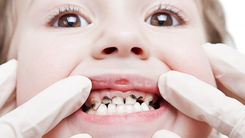 Sâu răng là một trong những nguyên nhân chủ yếu dẫn đến tình trạng đau nhức