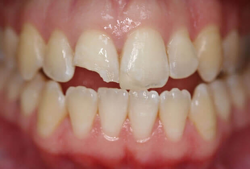 Mòn men răng hay sứt mẻ răng miệng là tình trạng nhiều người thường gặp 