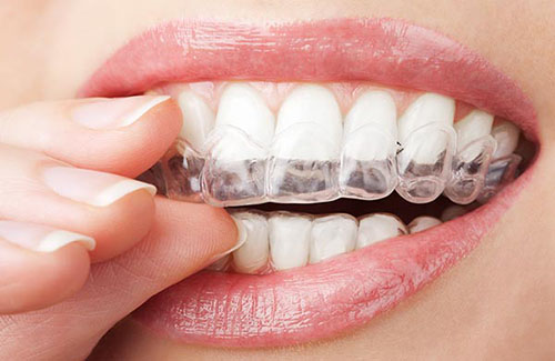 Chúng ta hoàn toàn có thể sử dụng phương pháp tẩy trắng răng tại nhà 