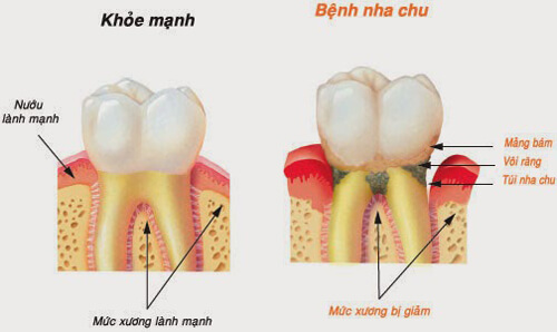 Nha chu là một trong những nguyên nhân hàng đầu dẫn đến hiện tượng rụng răng khi còn trẻ.