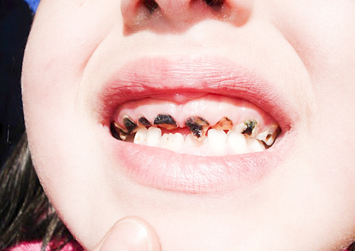Mảng bám đen trên răng là tình trạng thường gặp ở trẻ nhỏ