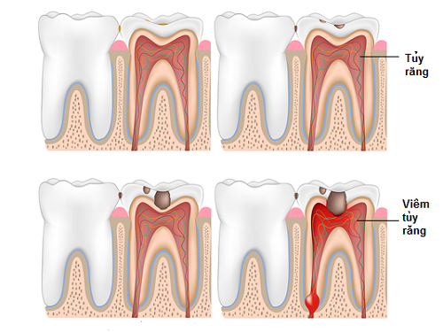 Giai đoạn bệnh viêm tủy răng 