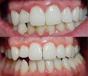  Ngăn ngừa sự hình thành của cao răng